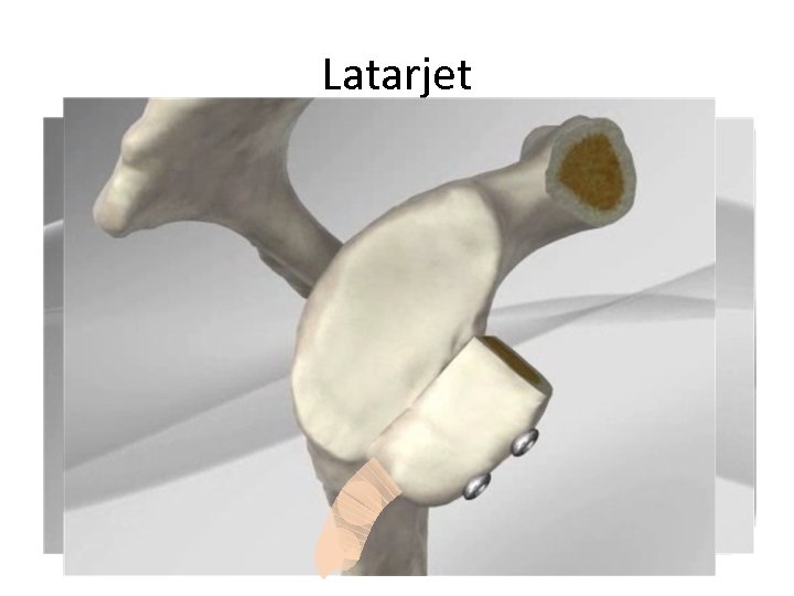 Latarjet 