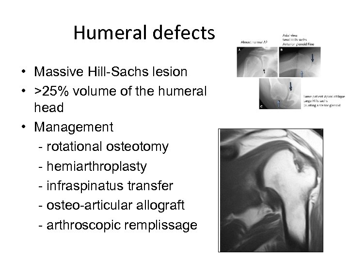 Humeral defects • Massive Hill-Sachs lesion • >25% volume of the humeral head •
