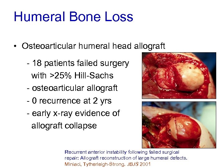 Humeral Bone Loss • Osteoarticular humeral head allograft - 18 patients failed surgery with