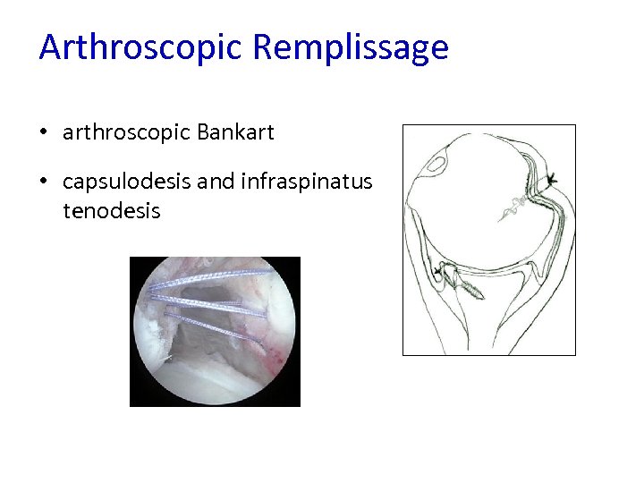 Arthroscopic Remplissage • arthroscopic Bankart • capsulodesis and infraspinatus tenodesis 