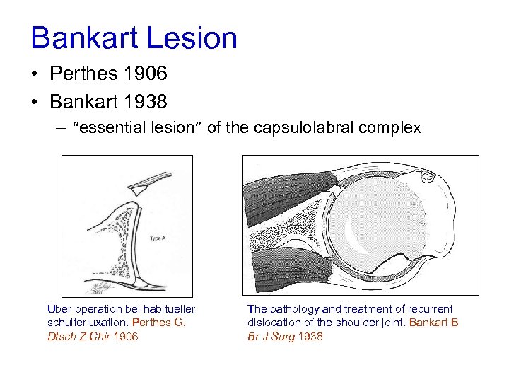 Bankart Lesion • Perthes 1906 • Bankart 1938 – “essential lesion” of the capsulolabral