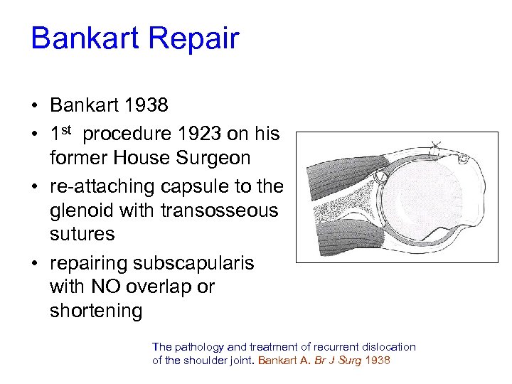 Bankart Repair • Bankart 1938 • 1 st procedure 1923 on his former House