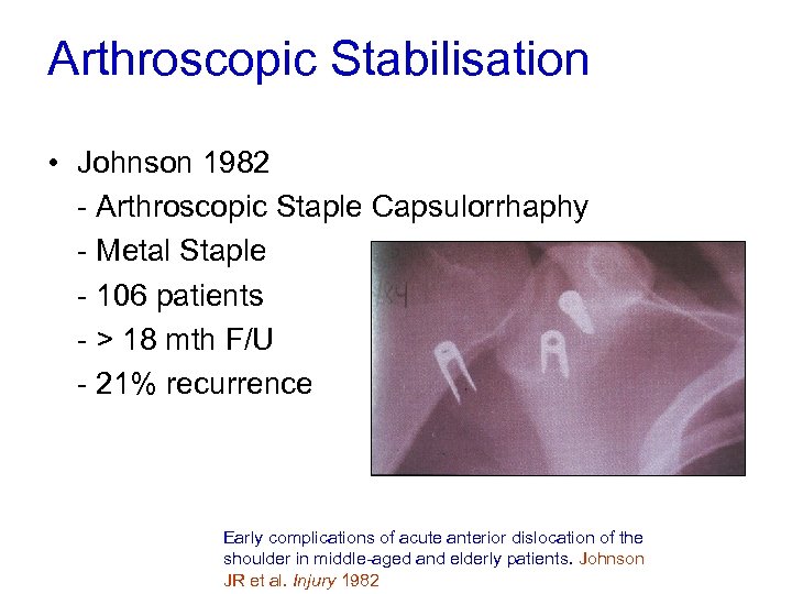 Arthroscopic Stabilisation • Johnson 1982 - Arthroscopic Staple Capsulorrhaphy - Metal Staple - 106