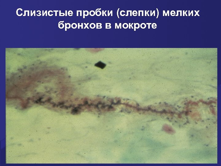 Слизистые пробки (слепки) мелких бронхов в мокроте 