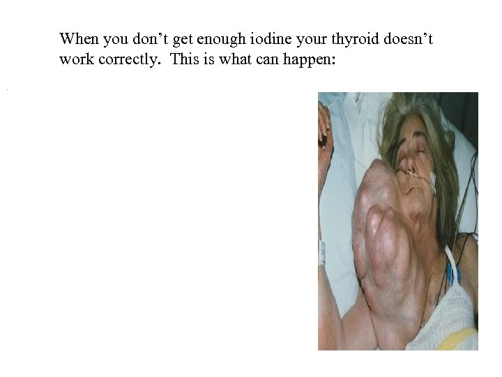 When you don’t get enough iodine your thyroid doesn’t work correctly. This is what