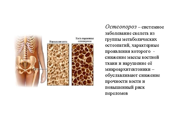 Остеопороз – системное заболевание скелета из группы метаболических остеопатий, характерные проявления которого снижение массы