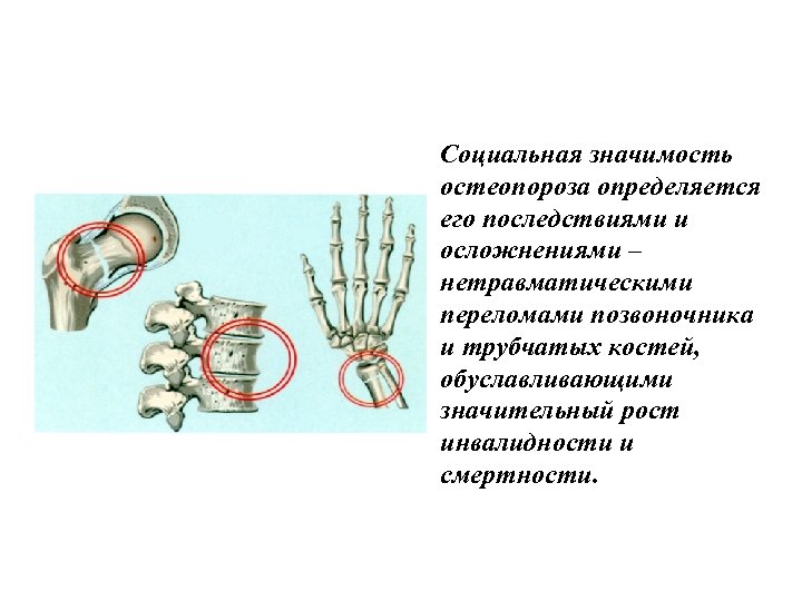 Социальная значимость остеопороза определяется его последствиями и осложнениями – нетравматическими переломами позвоночника и трубчатых