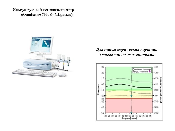 Ультразвуковой остеоденситометр «Omnisense 7000 S» (Израиль) Денситометрическая картина остеопенического синдрома 