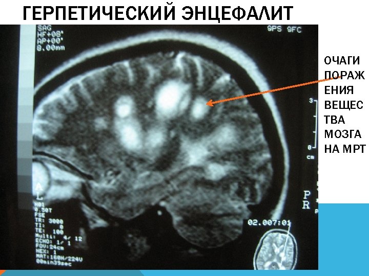 Энцефалит головного мозга у взрослых. Герпетический энцефалит кт. Герпетический энцефалит кт головного мозга. Герпетический менингоэнцефалит мрт.