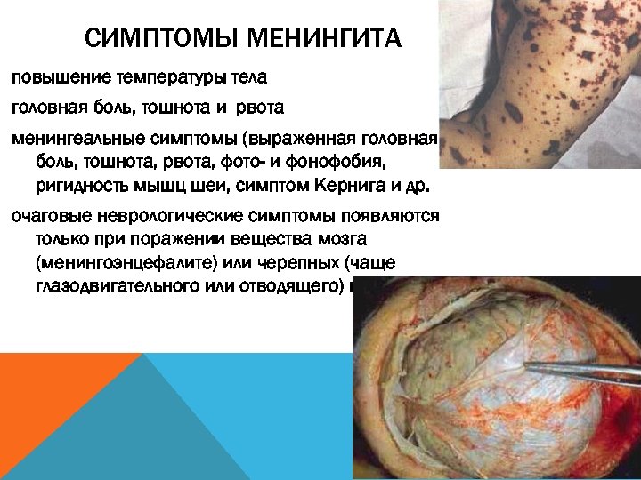 СИМПТОМЫ МЕНИНГИТА повышение температуры тела головная боль, тошнота и рвота менингеальные симптомы (выраженная головная