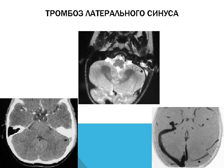 ТРОМБОЗ ЛАТЕРАЛЬНОГО СИНУСА 