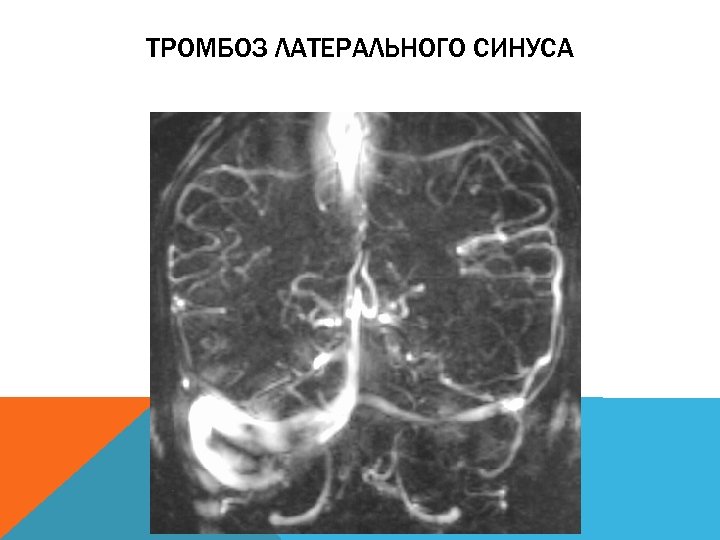 ТРОМБОЗ ЛАТЕРАЛЬНОГО СИНУСА 