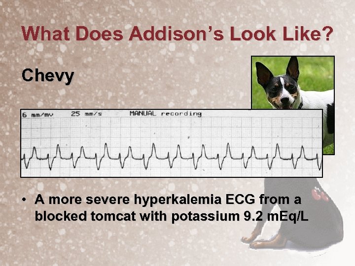 What Does Addison’s Look Like? Chevy • A more severe hyperkalemia ECG from a