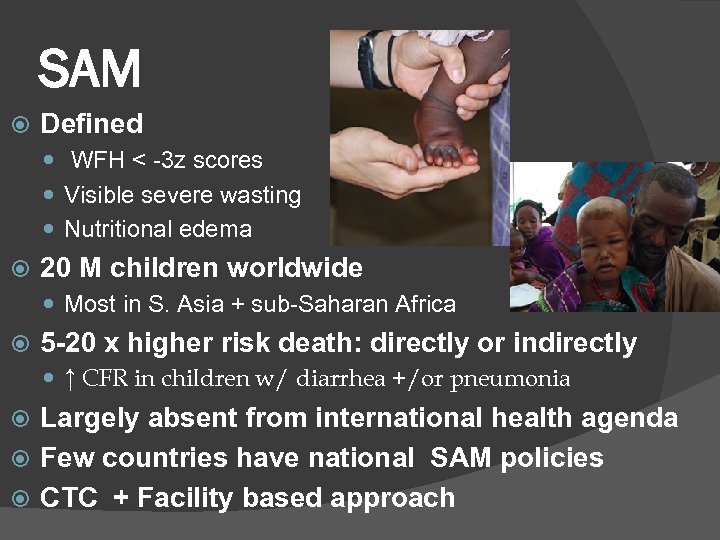SAM Defined WFH < -3 z scores Visible severe wasting Nutritional edema 20 M