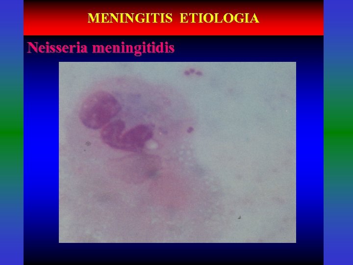 MENINGITIS ETIOLOGIA Neisseria meningitidis 