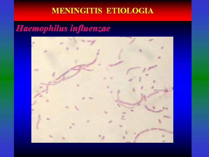 MENINGITIS ETIOLOGIA Haemophilus influenzae 