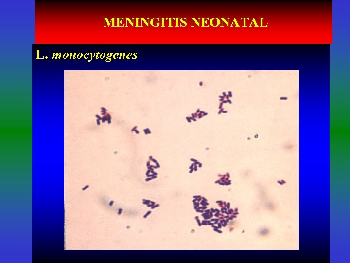 MENINGITIS NEONATAL L. monocytogenes 