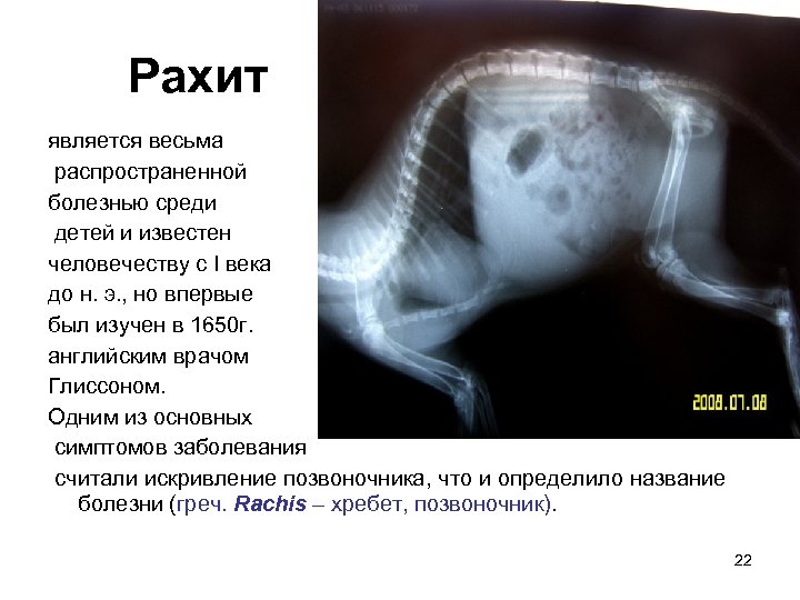 Рахит является весьма распространенной болезнью среди детей и известен человечеству с I века до