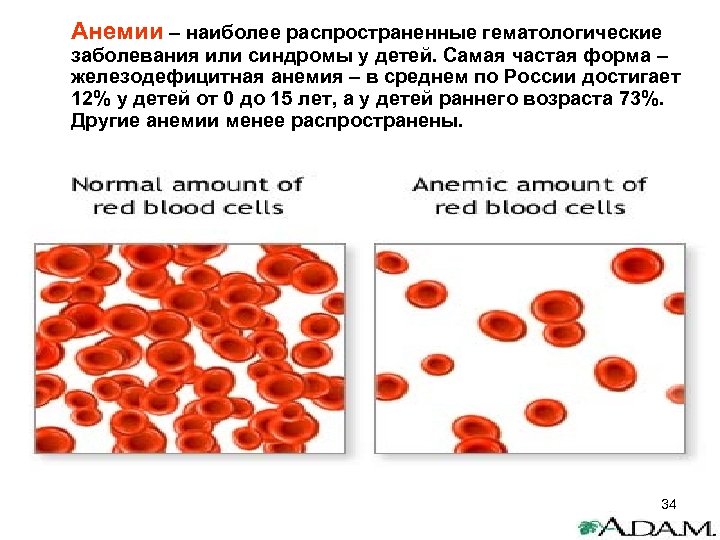 Анемии – наиболее распространенные гематологические заболевания или синдромы у детей. Самая частая форма –