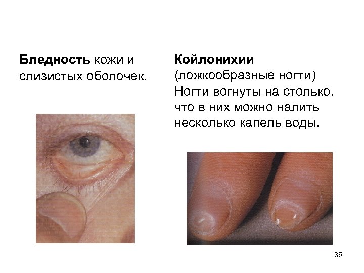 Бледность кожи и слизистых оболочек. Койлонихии (ложкообразные ногти) Ногти вогнуты на столько, что в