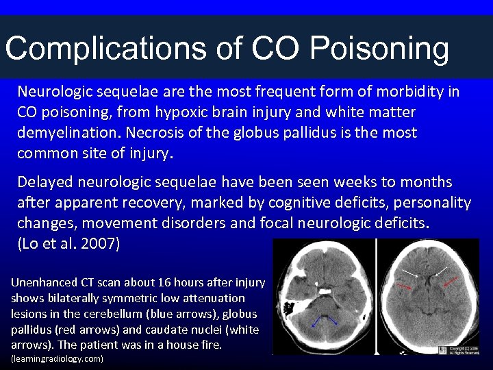 Complications of CO Poisoning Neurologic sequelae are the most frequent form of morbidity in