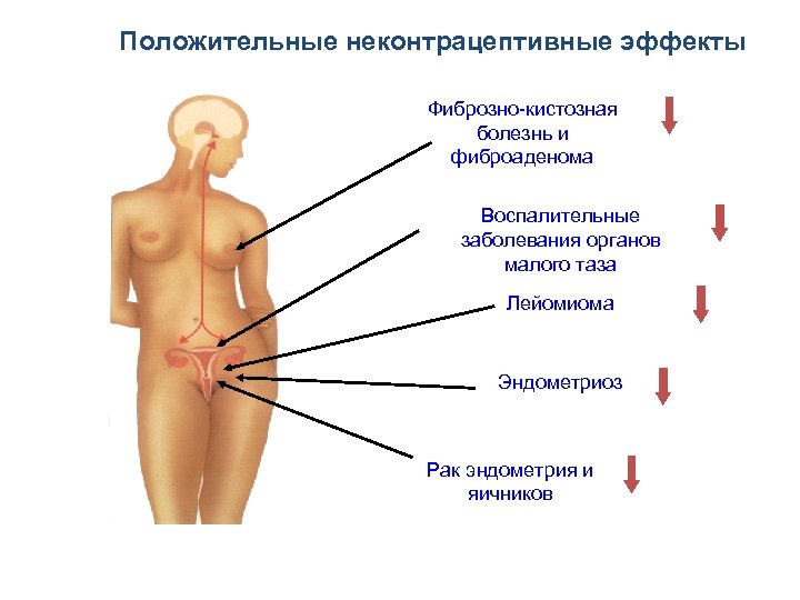 Положительные неконтрацептивные эффекты Фиброзно-кистозная болезнь и фиброаденома Воспалительные заболевания органов малого таза Лейомиома Эндометриоз