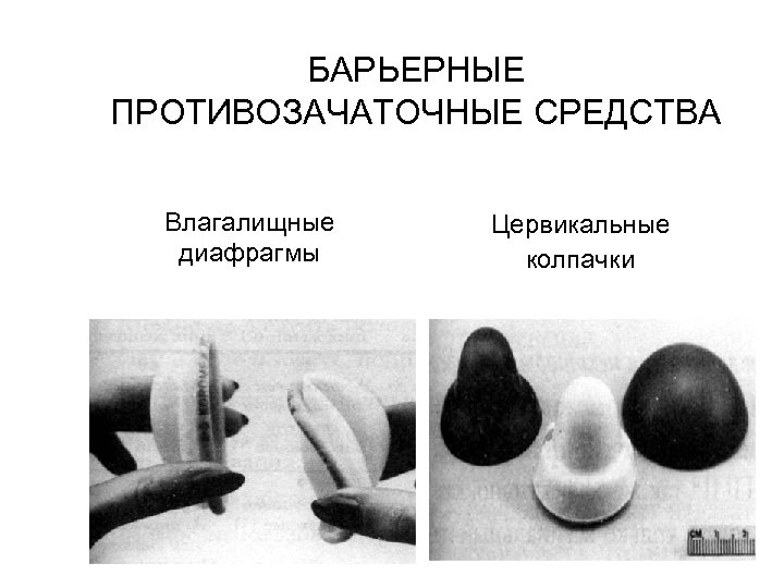 БАРЬЕРНЫЕ ПРОТИВОЗАЧАТОЧНЫЕ СРЕДСТВА Влагалищные диафрагмы Цервикальные колпачки 