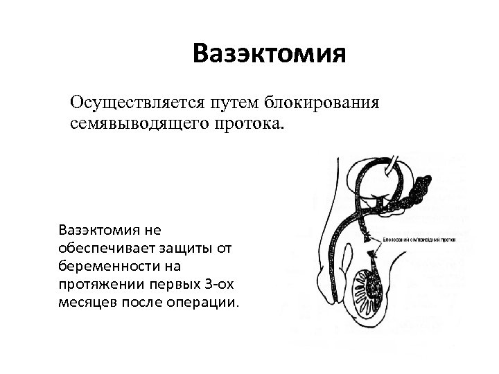  Вазэктомия Осуществляется путем блокирования семявыводящего протока. Вазэктомия не обеспечивает защиты от беременности на