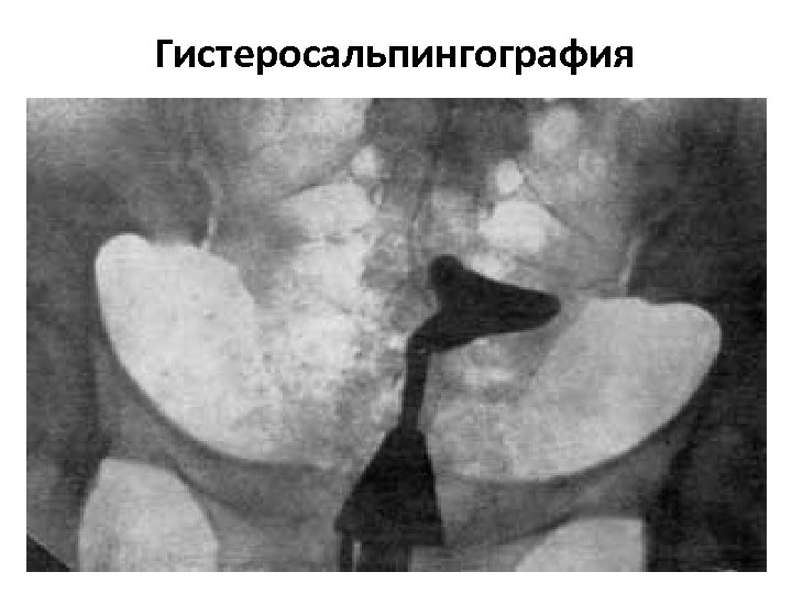 Гистеросальпингография 