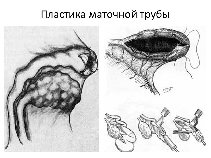 Пластика маточной трубы 