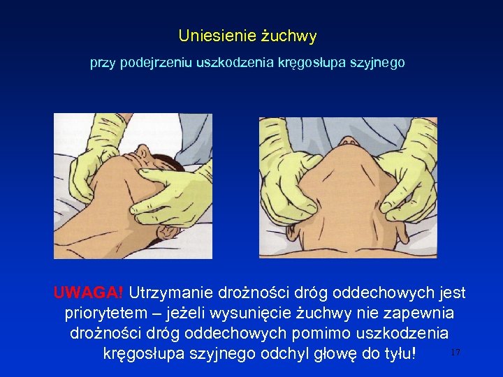 Uniesienie żuchwy przy podejrzeniu uszkodzenia kręgosłupa szyjnego UWAGA! Utrzymanie drożności dróg oddechowych jest priorytetem