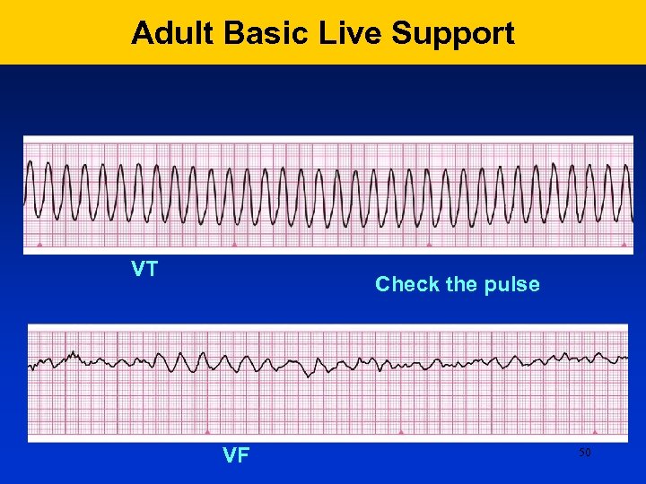 Adult Basic Live Support VT Check the pulse VF 50 