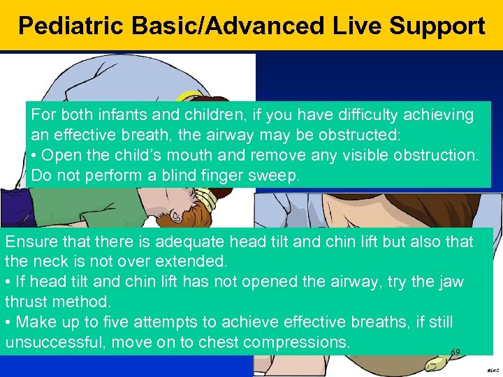 Pediatric Basic/Advanced Live Support For both infants and children, if you have difficulty achieving
