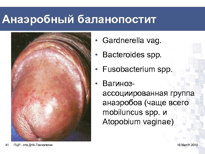 Анаэробный баланопостит • Gardnerella vag. • Bacteroides spp. • Fusobacterium spp. • Вагинозассоциированная группа