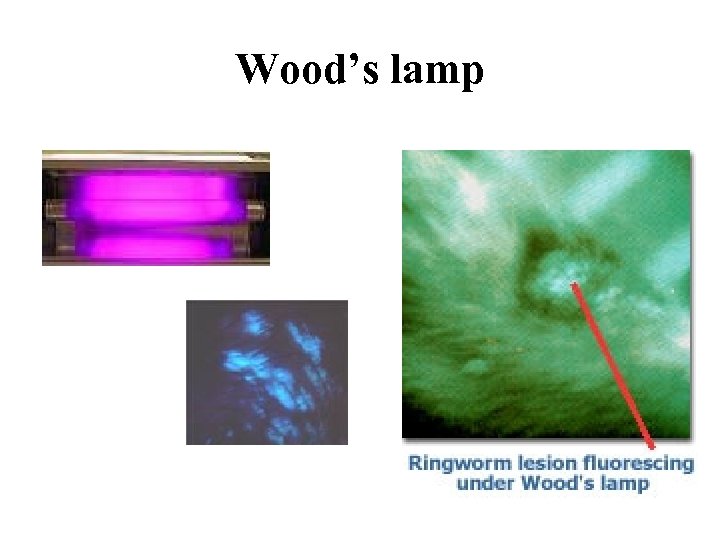 Wood’s lamp 