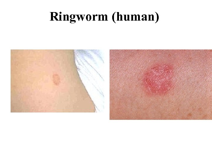 Ringworm (human) 