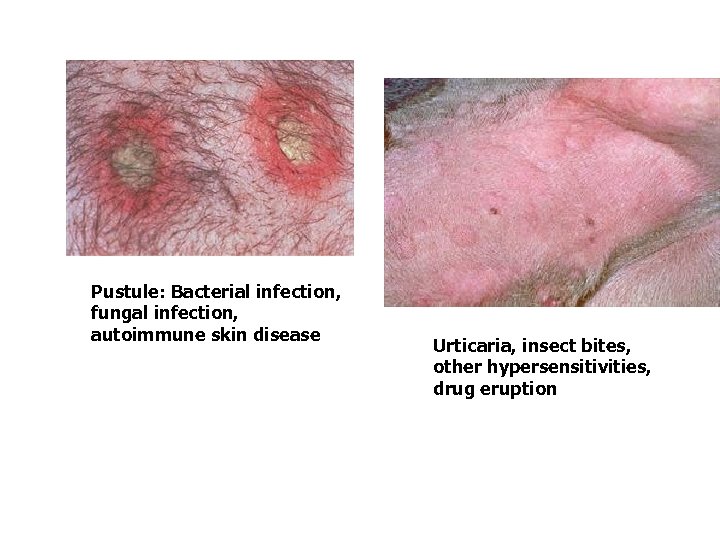 Pustule: Bacterial infection, fungal infection, autoimmune skin disease Urticaria, insect bites, other hypersensitivities, drug