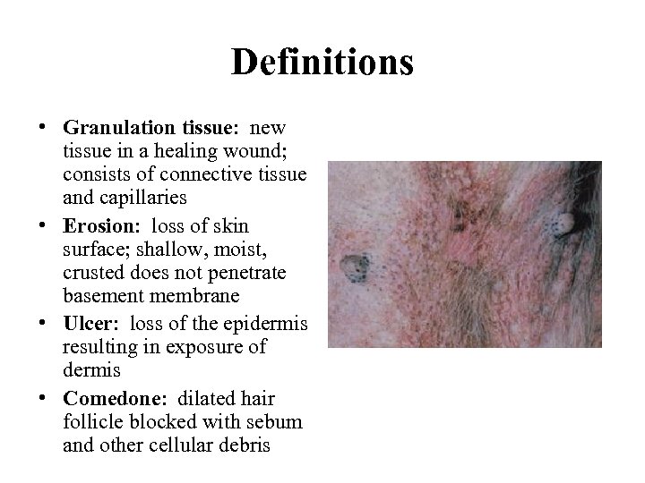 Definitions • Granulation tissue: new tissue in a healing wound; consists of connective tissue