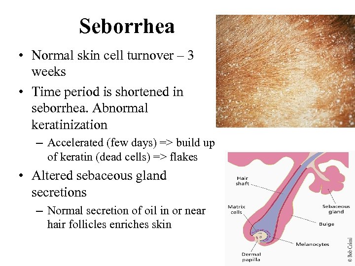 Seborrhea • Normal skin cell turnover – 3 weeks • Time period is shortened