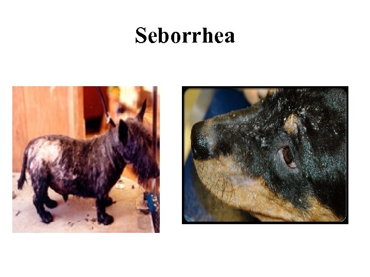 Seborrhea 