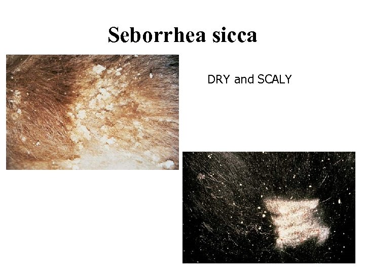 Seborrhea sicca DRY and SCALY 