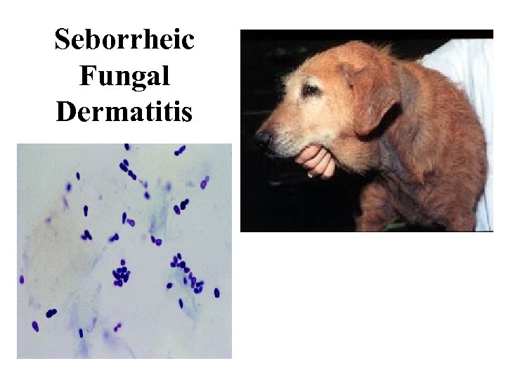 Seborrheic Fungal Dermatitis 