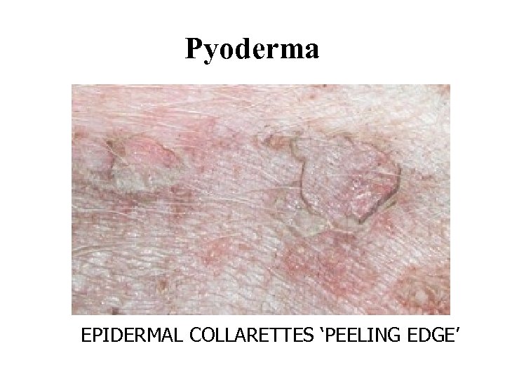 Pyoderma EPIDERMAL COLLARETTES ‘PEELING EDGE’ 