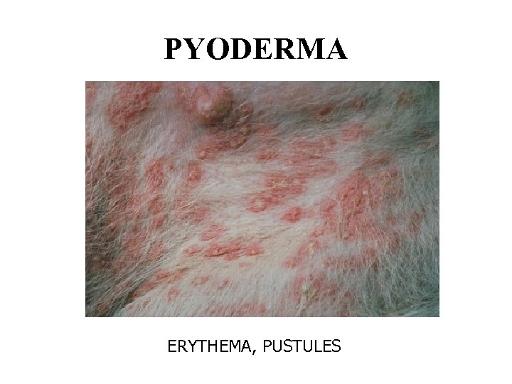 PYODERMA ERYTHEMA, PUSTULES 