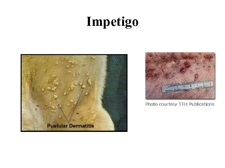 Impetigo 