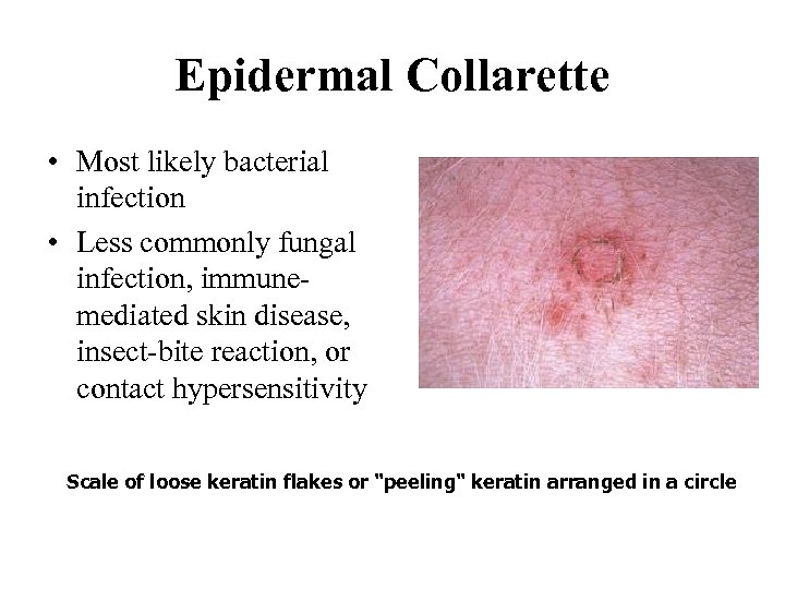 Epidermal Collarette • Most likely bacterial infection • Less commonly fungal infection, immunemediated skin