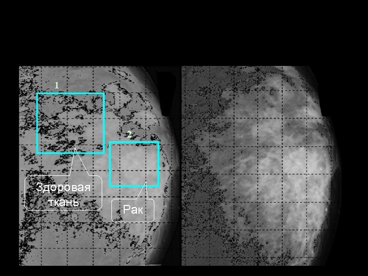 Здоровая ткань Рак 