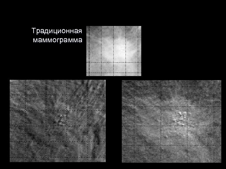 Традиционная маммограмма 