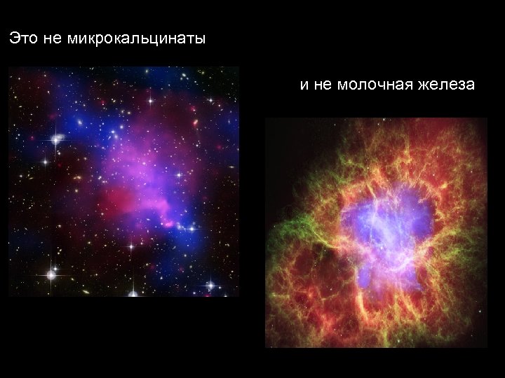 Это не микрокальцинаты и не молочная железа 