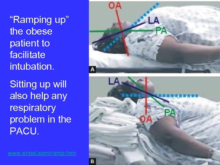 “Ramping up” the obese patient to facilitate intubation. Sitting up will also help any